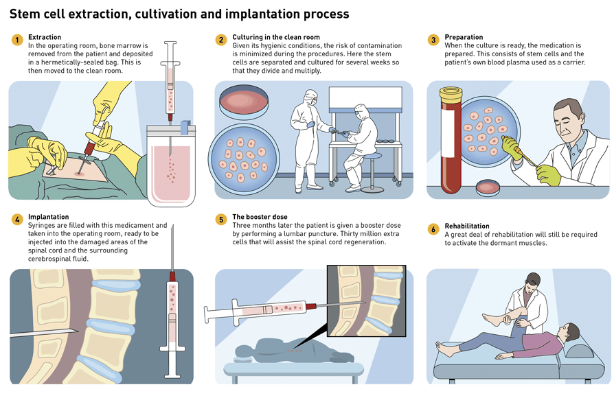 Steam cell extraction, cultivation and implantation process