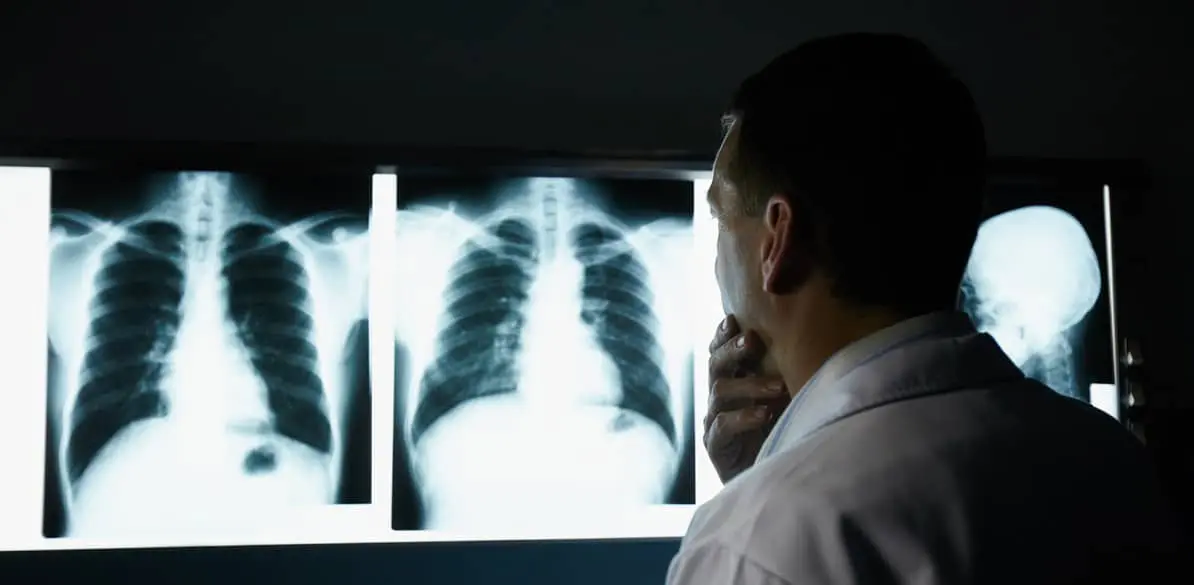 Sudden lodging of a blood clot in a pulmonary artery