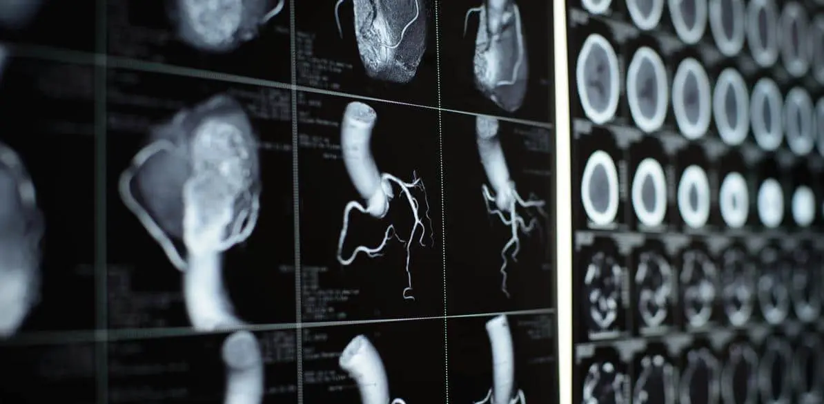 Secondary arterial hypertension of non-renal origin and its influence on driving These clinical presentations of AH are less frequent than essential or renal AH, but they preclude driving from their onset