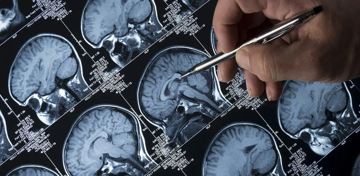 Trastornos convulsivos y su interferencia al volante La epilepsia es un trastorno intermitente del sistema nervioso