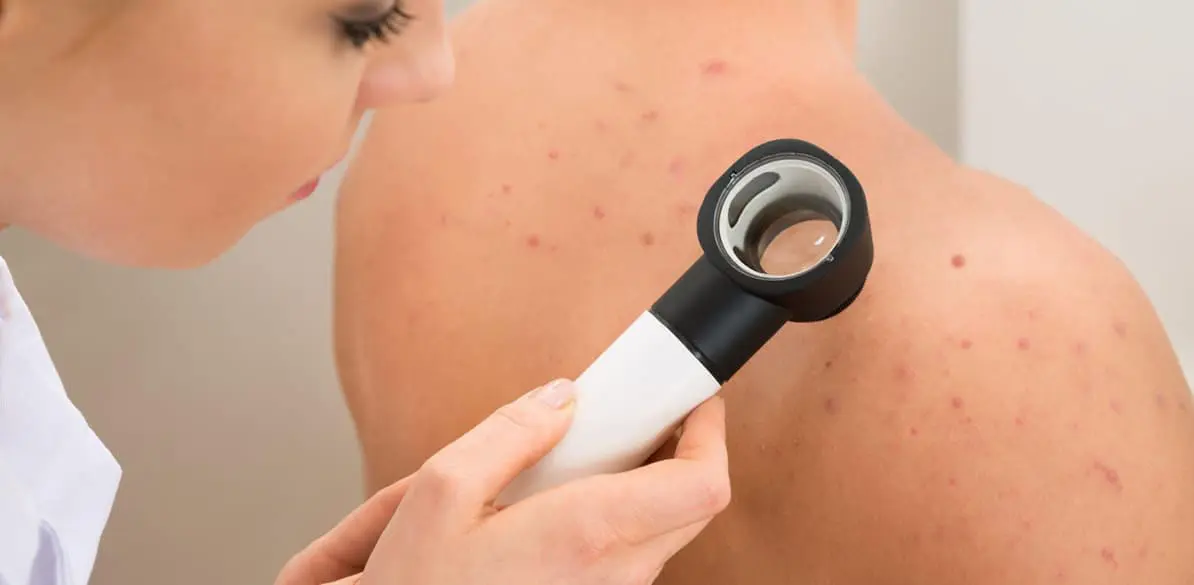 Acné, pseudofoliculitis, quiste epidérmico y su influencia al volante La piel es el órgano de contacto del conductor con los mandos de su vehículo